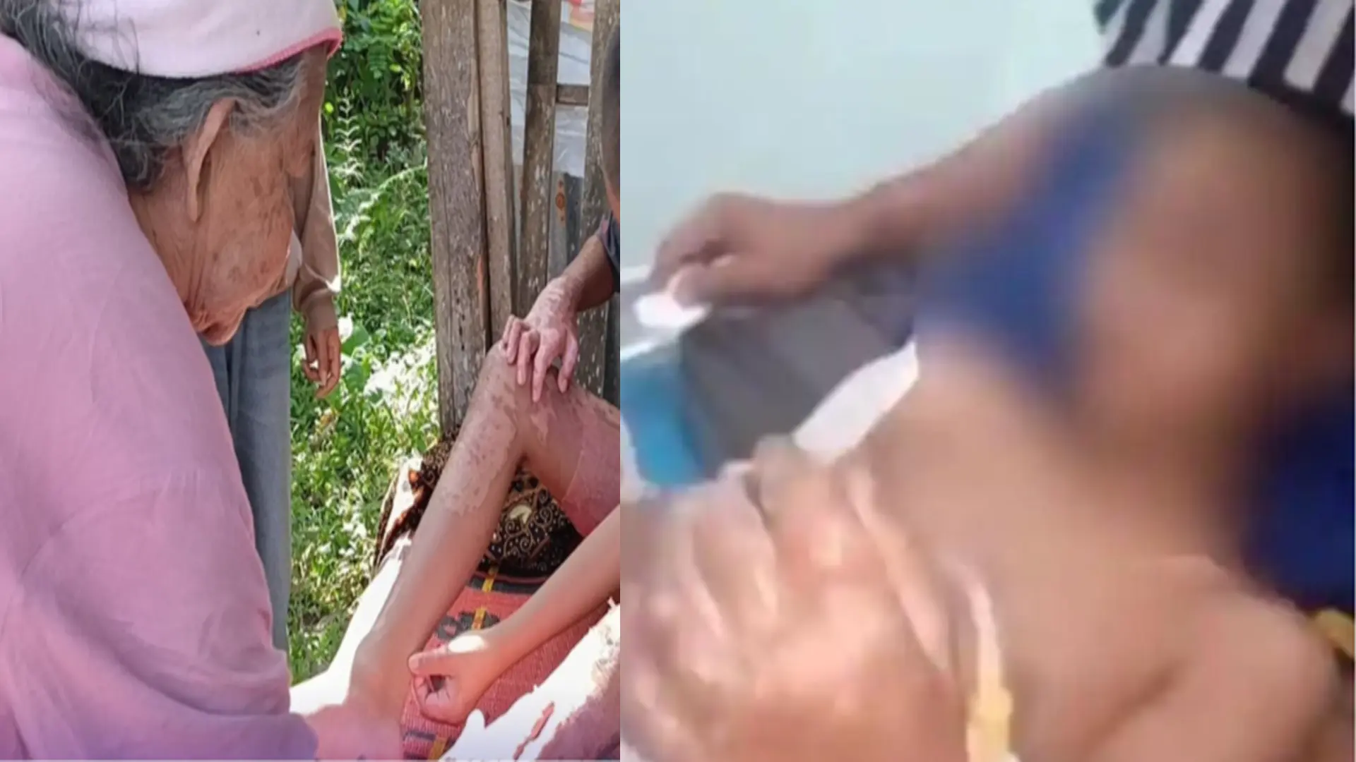 Cerita Pilu Sahid, Santri Korban Dugaan Pembakaran di Ponpes Lombok Tengah