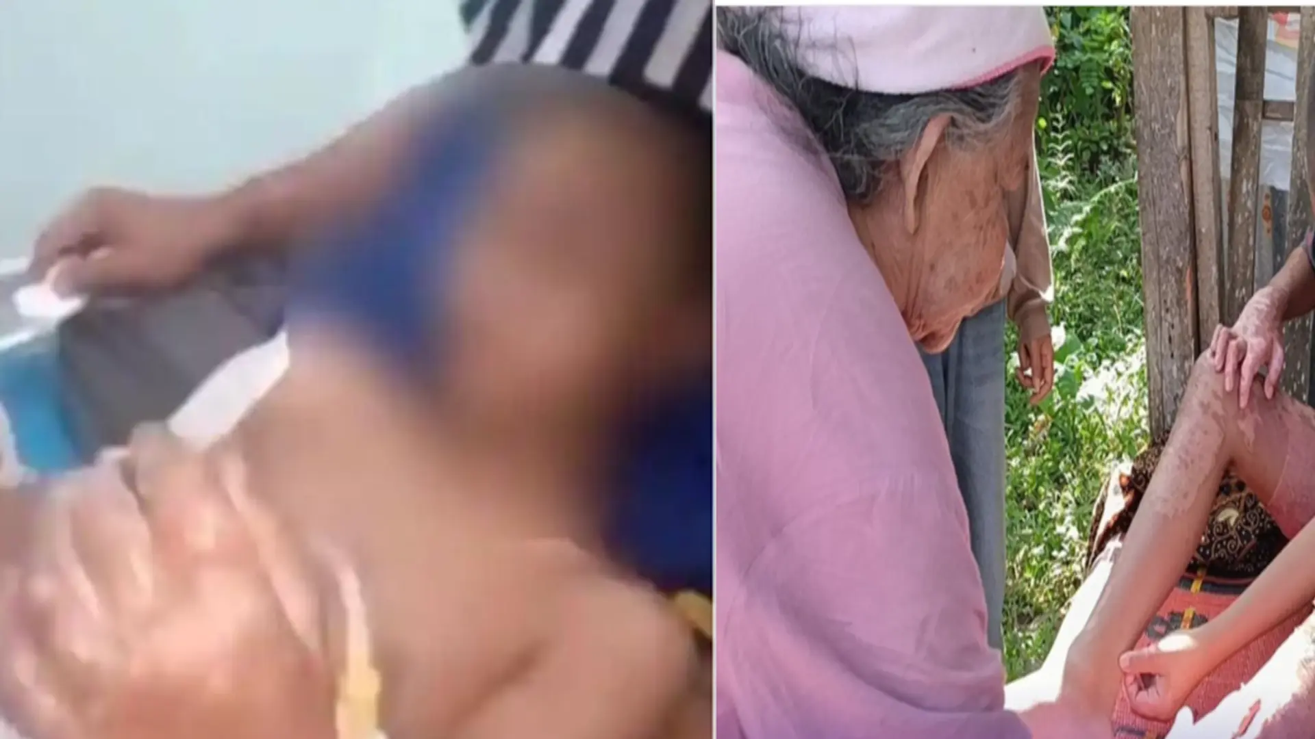 Viral Kasus Santri Dibakar di Lombok Tengah, Polisi Mulai Selidiki Dugaan Kekerasan Ponpes