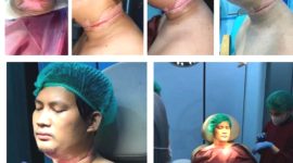 Luthfi Hakim Fauzi, korban kabel menjuntai saat menjalani pengobatan. Foto: Dok.LBH Medan