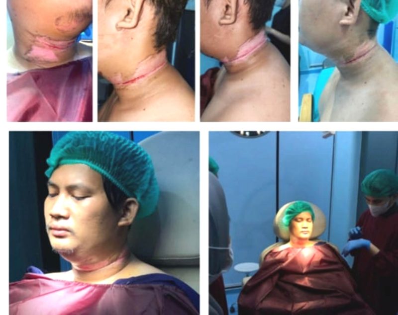 Luthfi Hakim Fauzi, korban kabel menjuntai saat menjalani pengobatan. Foto: Dok.LBH Medan
