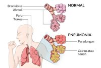 Gambar penyakit Pneumonia. Gambar: Alodokter