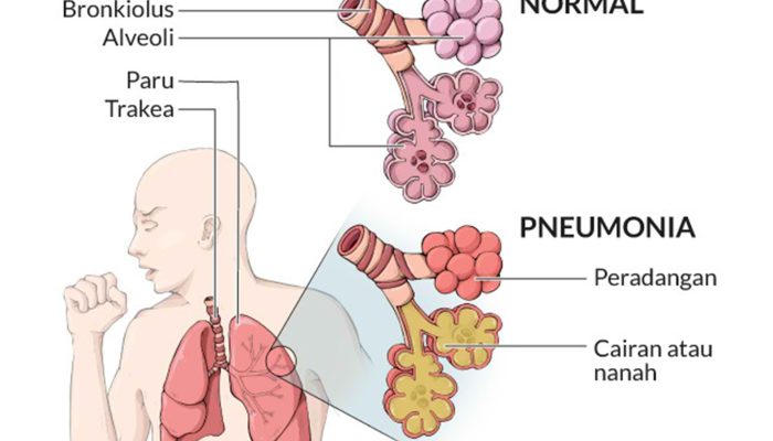 Benarkah Mandi Malam dan Kipas Angin Penyebab Pneumonia? Simak Penjelasannya