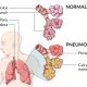Pneumonia