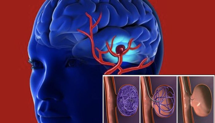 Aneurisma Otak Bisa Jadi “Bom Waktu” di Dalam Tubuh, Ahli Peringatkan Risiko Pecah seperti yang Dialami Kim Kardashian