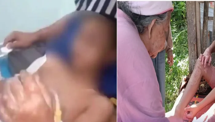 Viral Kasus Santri Dibakar di Lombok Tengah, Polisi Mulai Selidiki Dugaan Kekerasan Ponpes